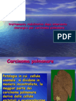 Carcinoma Polmonare