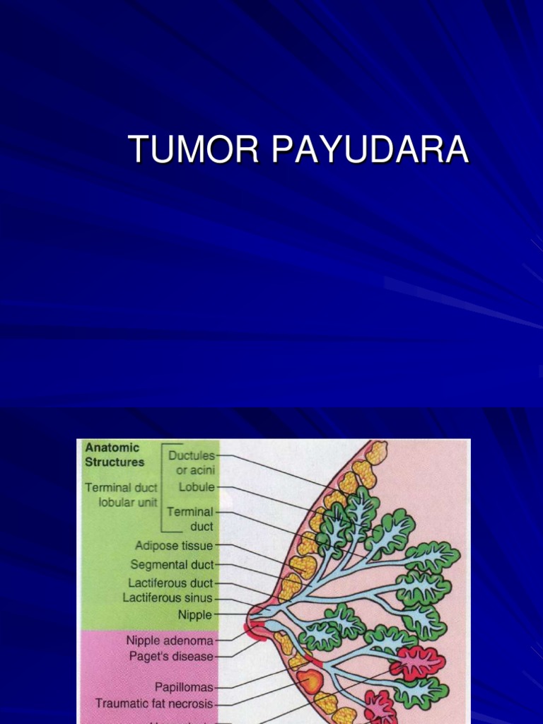 1 TUMOR PAYUDARA.pdf