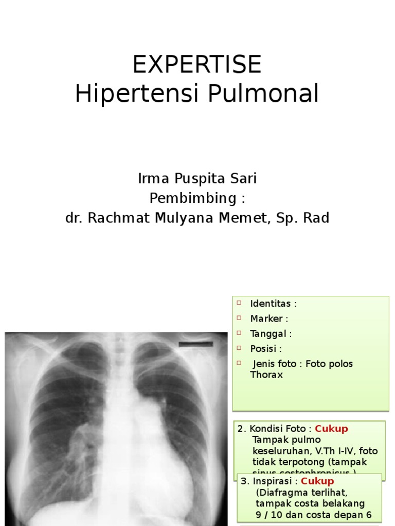 Penyakit Hipertensi Pulmonal Gejala Penyebab Pengobatan
