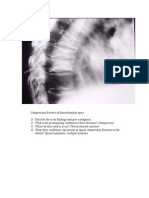 Compression Fracture of Thoracolumbar Spine