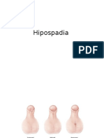 Hipospadia