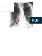 radiologi bronkiektasis