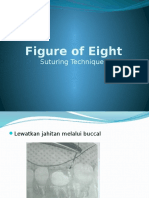 Figure of Eight suturing