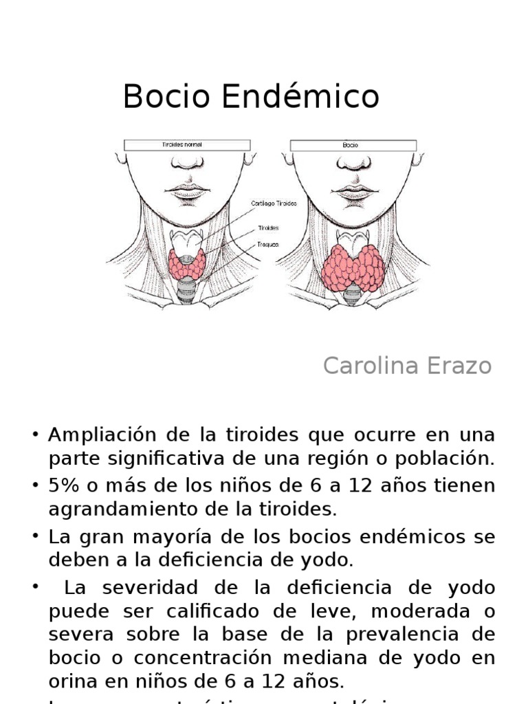 Bocio Endemico Tiroides Hormona Estimulante De La Tiroides
