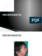 MICROGNATIA 
