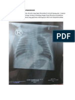 Gambaran Radiologi Bronchopneumonia