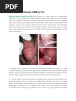 Download Gambar Penyakit Kelamin Kutil Pada Pria by japras SN295595705 doc pdf