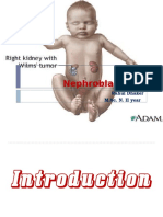 96657670-Nephroblastoma-ppt