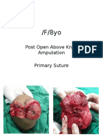 8yo Above Knee Amputation Primary Suture