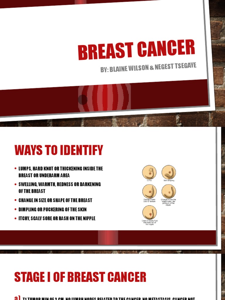 Understanding Breast Cancer Presentation | PDF | Wellness