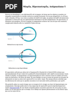 Diferencia Entre Miopía, Hipermetropía, Astigmatismo Y Presbicia