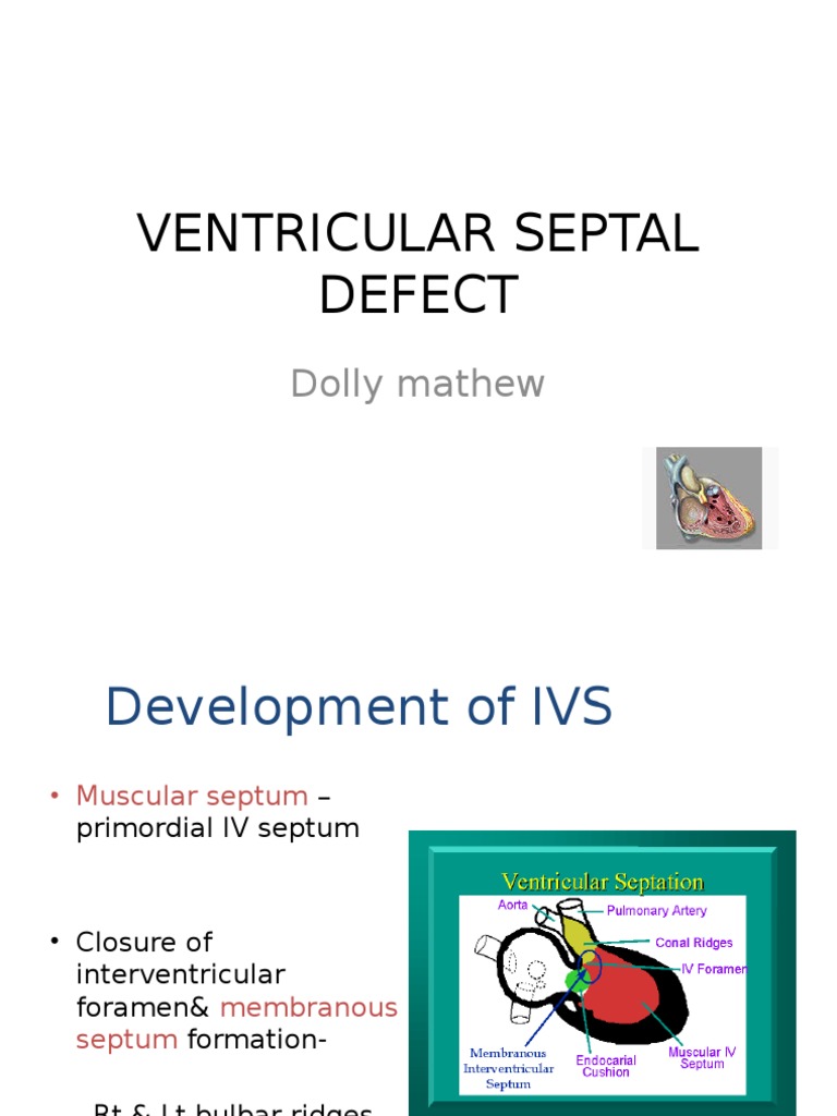 Understanding Ventricular Septal Defect | PDF | Circulatory System ...