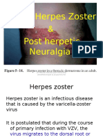 Post Herpetic Neuralgia and Herpes Zoster
