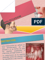 MALOCLUSION