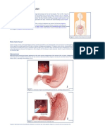 Gastric Cancer