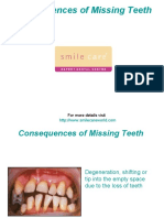 Consequences of Missing Teeth
