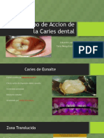 Mecanismo de Accion de La Caries Dental