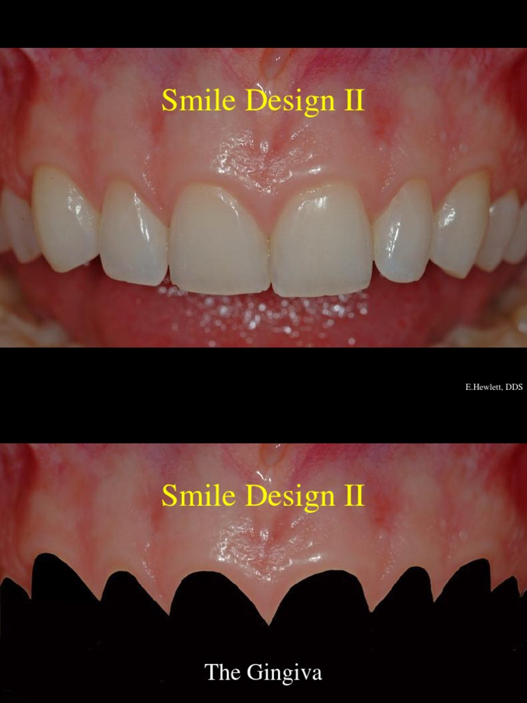 Smile Design: Key Elements Explained | PDF | Mouth | Dentistry