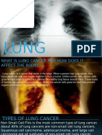 lung cancer presentation-2