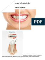 7 Remedios Caseros Para La Gingivitis