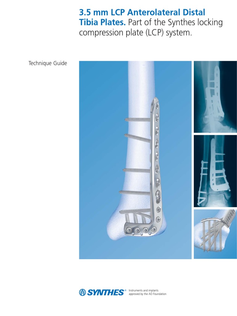 3.5 MM LCP Anterolateral Distal de Tibia | PDF | Screw | Drill