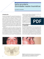 26 Rinoplastia Secundaria Por Deformidades Nasales Traum Ticas 2005 Traumatismos Maxilofaciales y Reconstrucci N Facial Est Tica