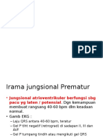 Junctional Rhytm