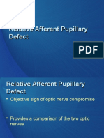 Relative Afferent Pupillary Defect