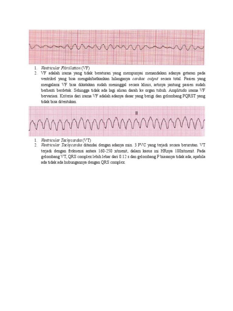 Ventricular Fibrillation | PDF