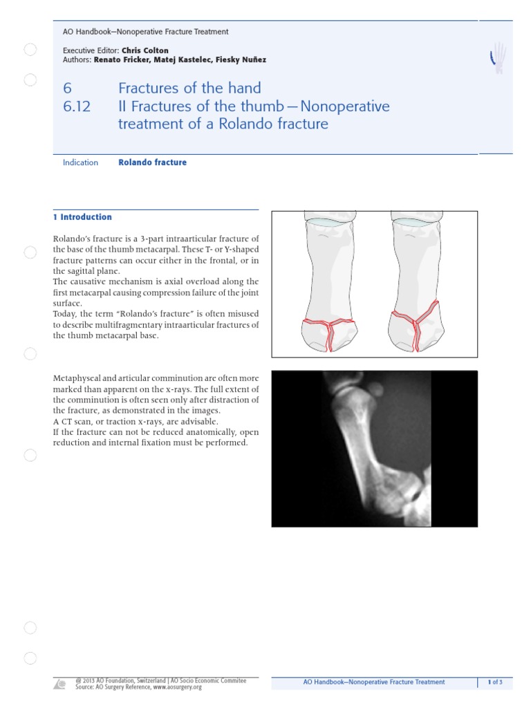 Nonoperative Treatment of Rolando Fracture | PDF