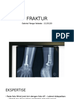 Humeral Fracture
