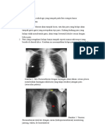 Pemeriksaan Radiologi Pneumothorax