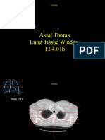 Axial Thorax Lung Tissue Window 401b