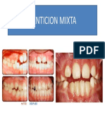 Denticion Mixta