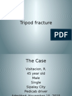 Tripod Fracture