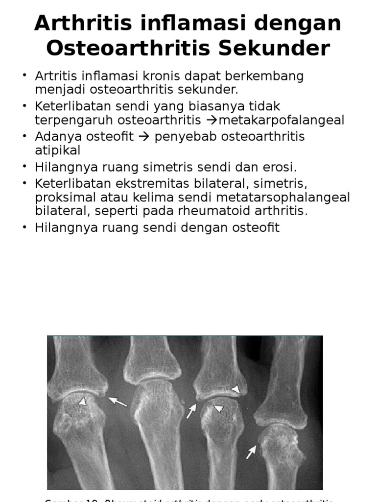 Artroza, cea mai frecventă boală reumatică