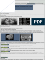 Hipomovilidad Mandibular Cronica