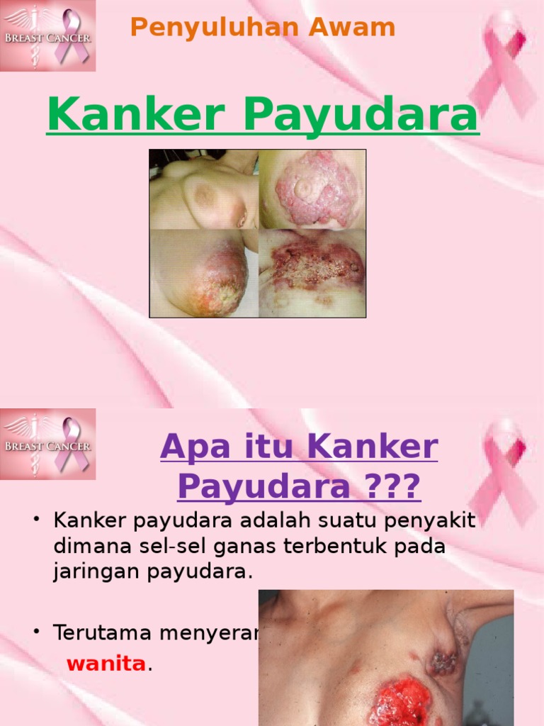 Panduan Penatalaksanaan Kanker Payudara