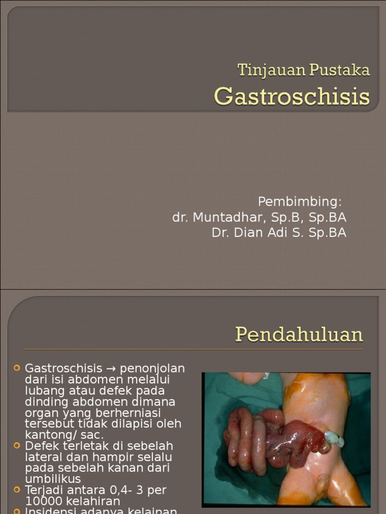 Gastroschisis.ppt