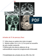 Carcinoma sebáceo // Radiologia