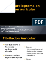 EKG en Fibrilación Auricular