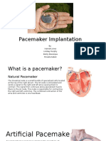 Pacemaker Implantation Powepoint