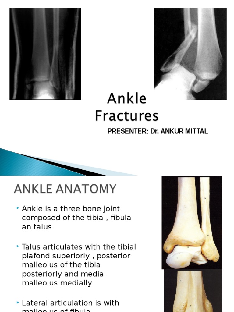 Ankle Fracture | PDF | Ankle | Musculoskeletal System