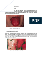 Jenis Kandidiasis Kronik Mulut