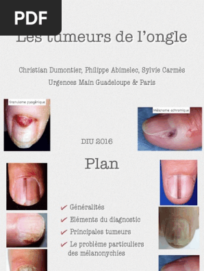 Tumeurs Ongle 2016 Diu Melanome Metastase