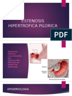 Estenosis Hipertrofica Pilorica