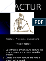Bone Break Guide: Types, Signs, Treatment for Fractures