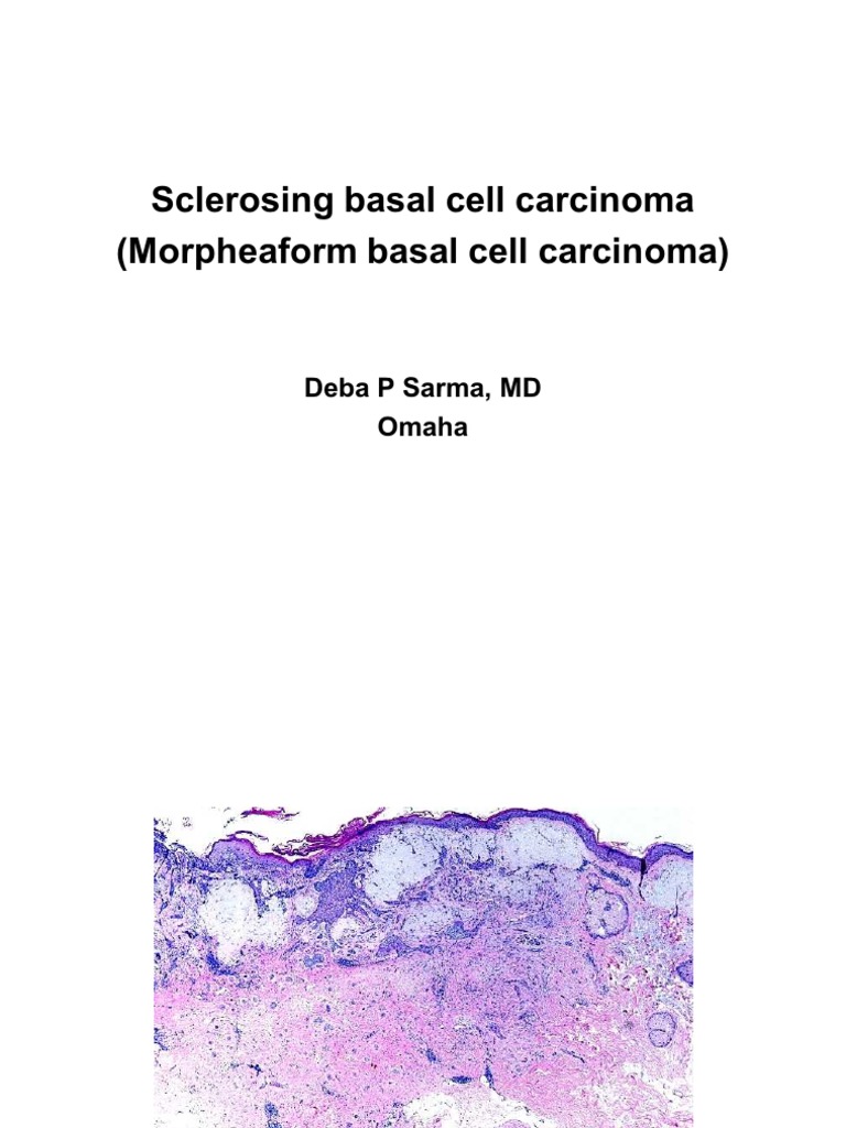 Sclerosing Basal Cell Carcinoma (Morpheaform Basal Cell Carcinoma)