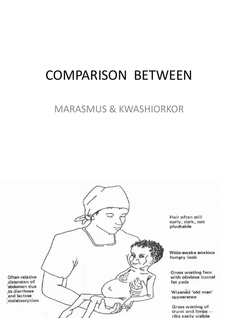 COMPARISON BETWEEN MARASMUS &amp; KWASHIORKOR.pdf