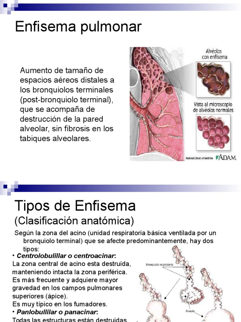 Enfisema